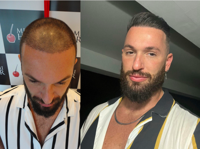 diego-hypolito-implante-capilar-antes-e-depois