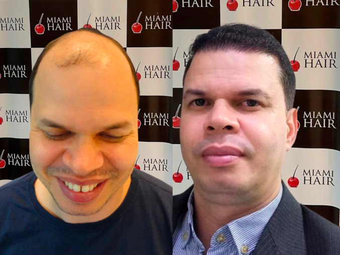 miami-hair-cliente-implante-antes-e-depois-10