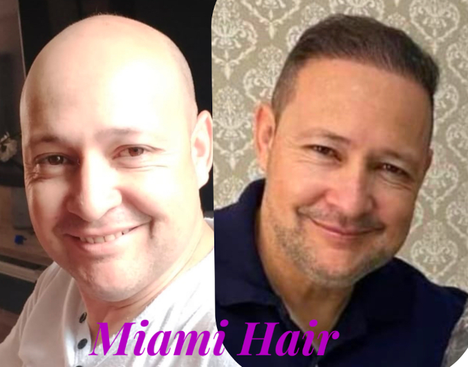 miami-hair-cliente-implante-antes-e-depois-2