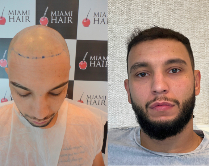 miami-hair-cliente-implante-antes-e-depois-4