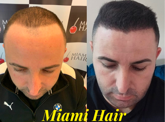 miami-hair-cliente-implante-antes-e-depois-7